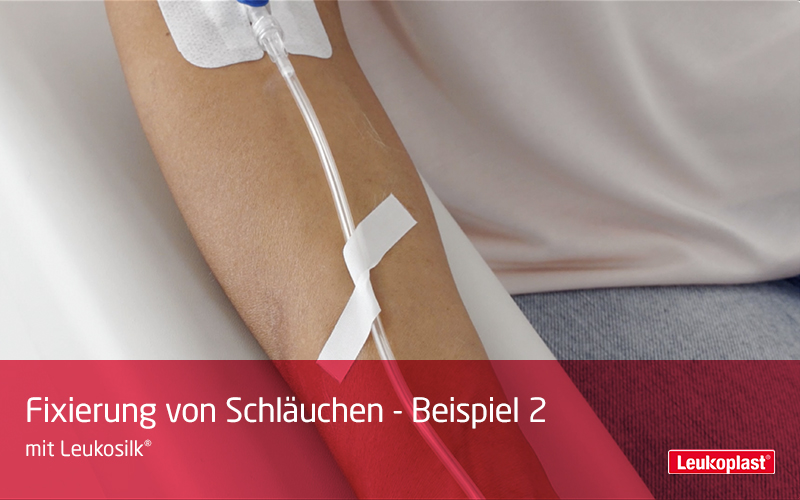 Dieses Video demonstriert wie Schläuche mit Hilfe des hautfreundlichen Rollenpflasters befestigt werden können: Das Fachpersonal fixiert den Schlauch am Unterarm des Patienten mit dem Leukosilk® Rollenpflaster. Dieses Video demonstriert wie Schläuche mit Hilfe des hautfreundlichen Rollenpflasters befestigt werden können: Das Fachpersonal fixiert den Schlauch am Unterarm des Patienten mit dem Leukosilk® Rollenpflaster.